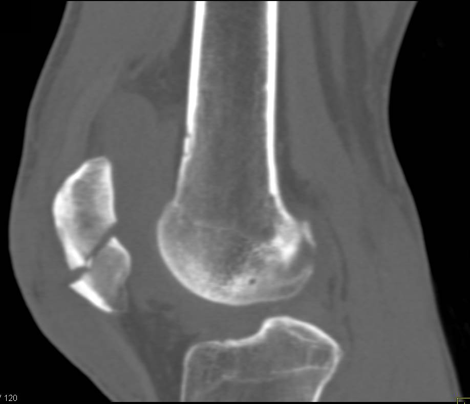 Patella Fracture - CTisus CT Scan