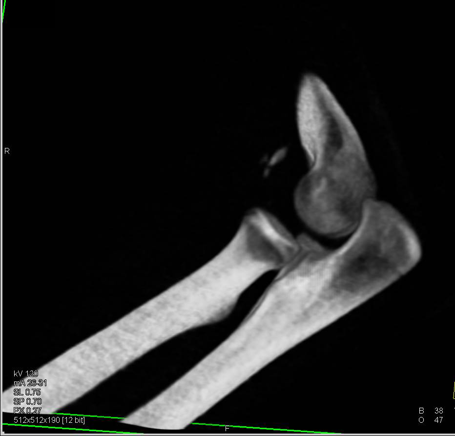 Elbow Fracture with Reduced Dislocation - CTisus CT Scan