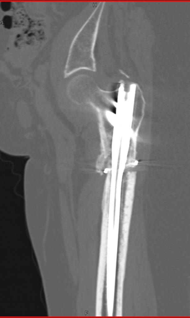Nonunion of a Femur Fracture with Hardware in Place - CTisus CT Scan