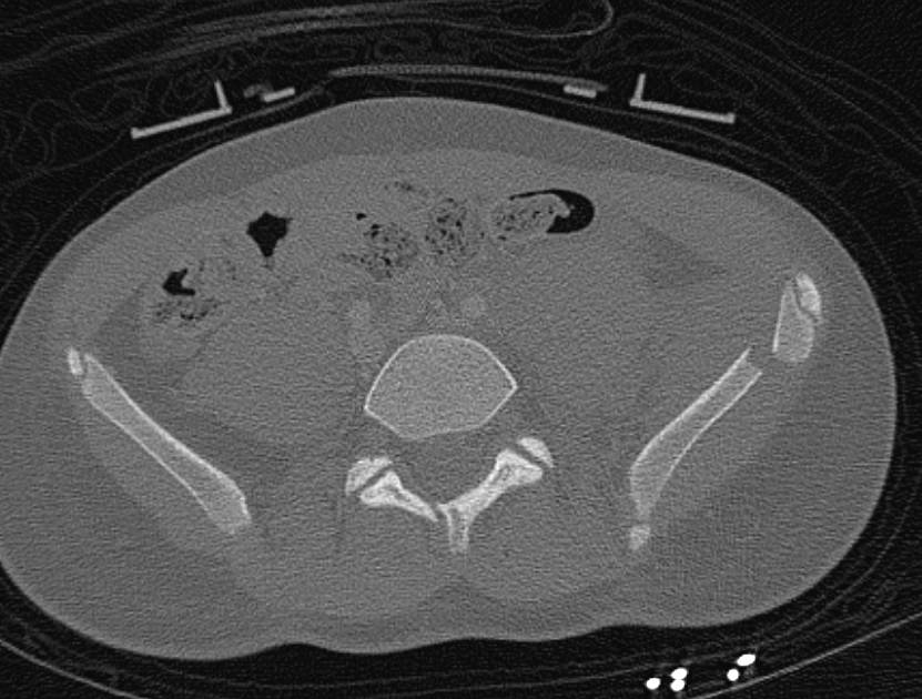 MVA with series of Complex Pelvic Fractures Including Iliac Wing, Sacrum and Symphysis Pubis - CTisus CT Scan