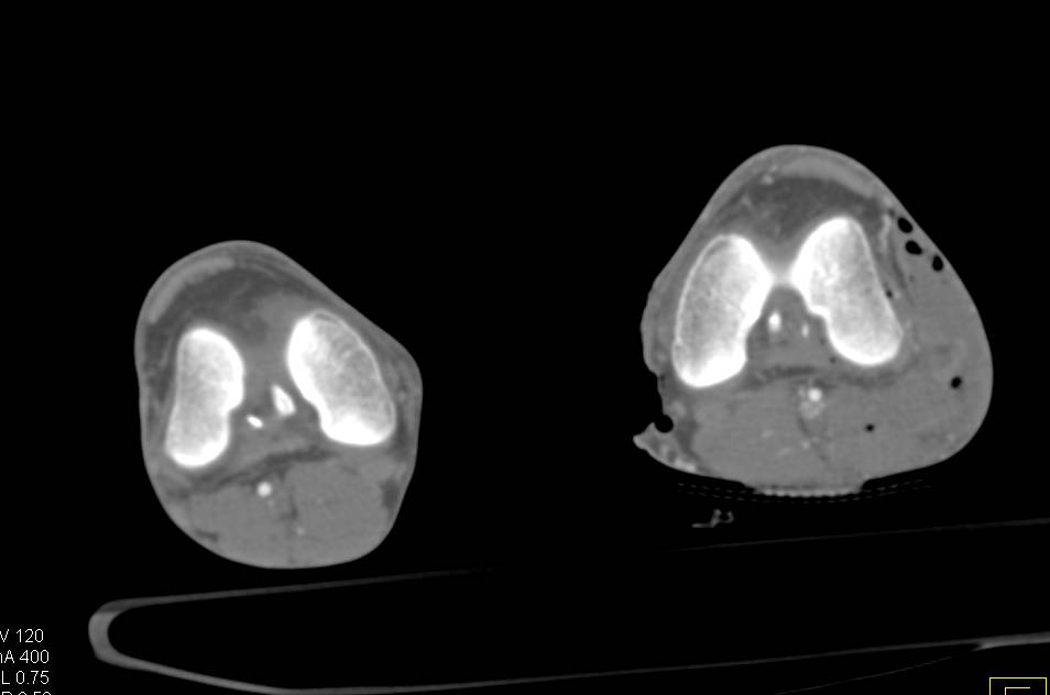 Gunshot Wound to Lower Leg with Soft Tissue and Bone Trauma and Vascular Injury - CTisus CT Scan
