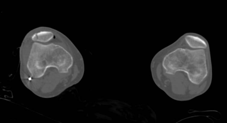 Patellar Fracture due to Gun Shot Wound - CTisus CT Scan