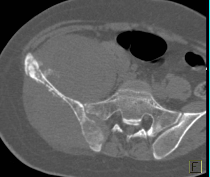 Osteosarcoma of the Iliac Wing - CTisus CT Scan