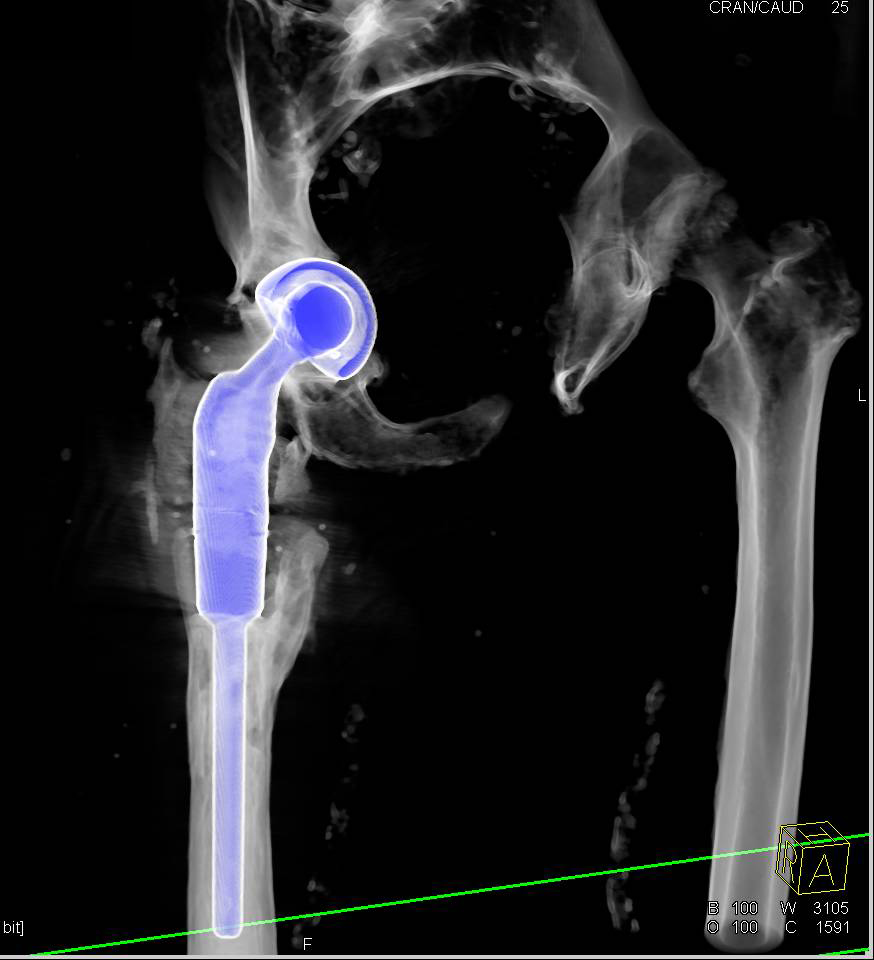 3D of Failing Right Total Hip Replacement - CTisus CT Scan