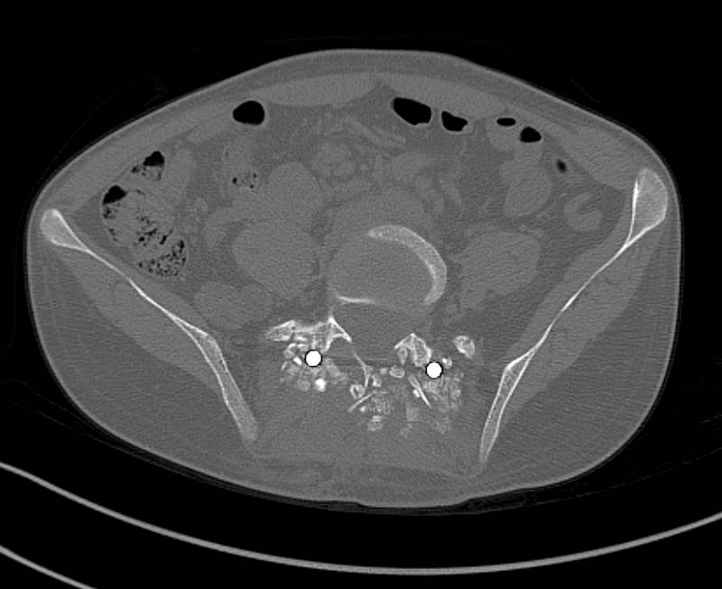 Hardware Map in Patient with Spinal Surgery - CTisus CT Scan