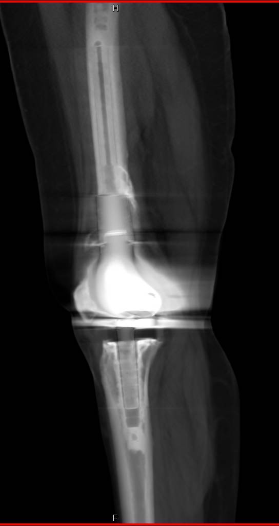 Pillow of Total knee replacement, X-ray - Media Storehouse