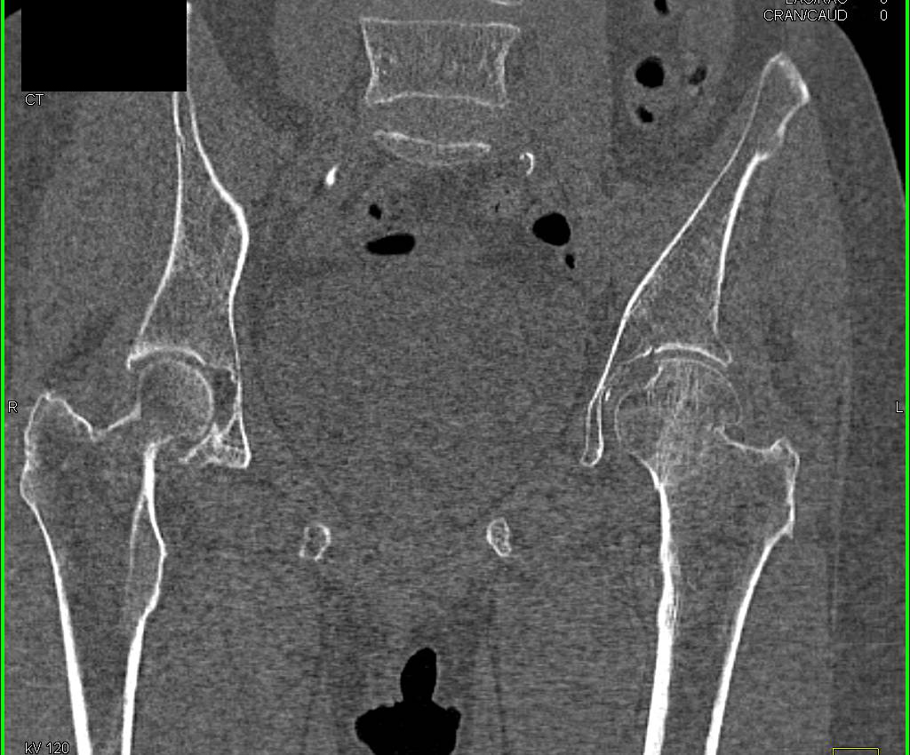 impacted subcapital fracture