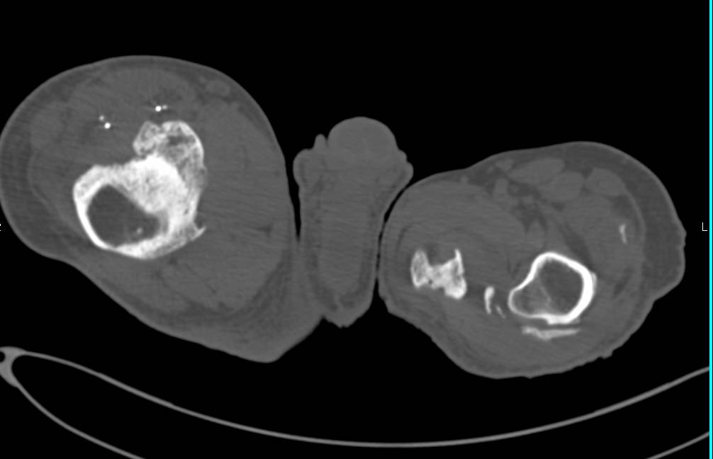 Heterotopic Ossification Both Hips in a Patient who is Quadriplegic - CTisus CT Scan