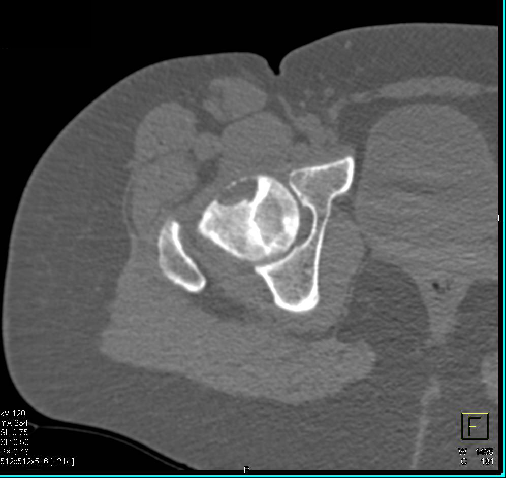 Avascular Necrosis with CT Crescent Sign for AVN - CTisus CT Scan