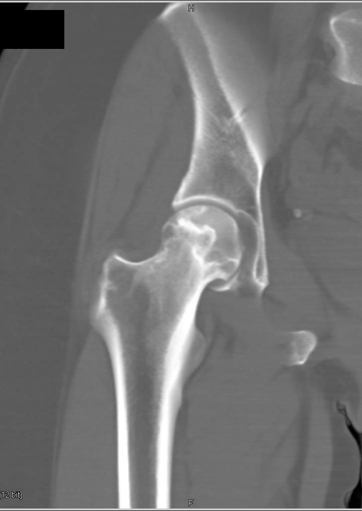 Avascular Necrosis with CT Crescent Sign for AVN - Musculoskeletal Case