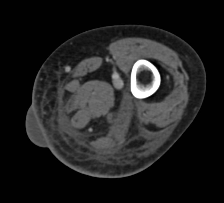 Bullous Changes in the Soft Tissue - Musculoskeletal Case Studies ...