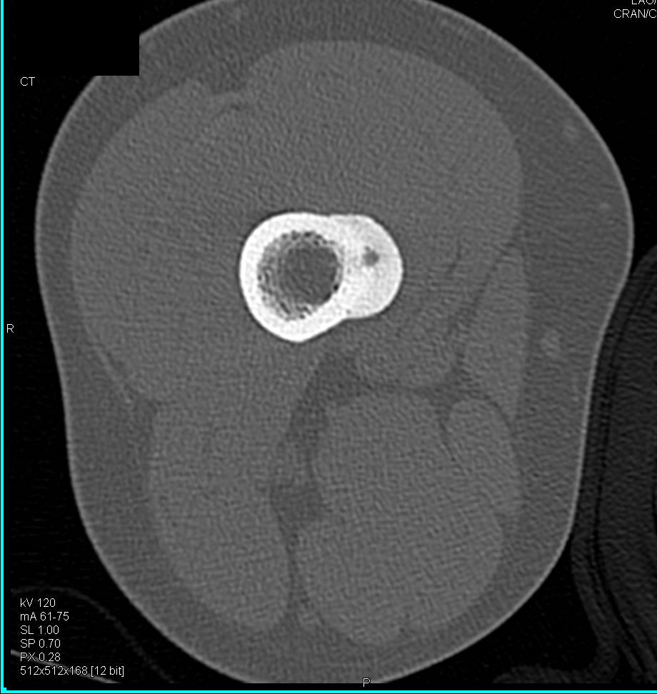 Radiofrequency Ablation (RFA) of an Osteoid Osteoma - CTisus CT Scan