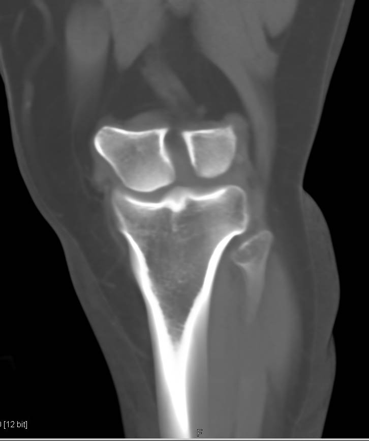 Remodeling of the Distal Femur - CTisus CT Scan