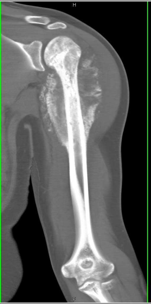 Кт костей. Остеосаркома плечевой кости рентген. Хондросаркома плечевой кости на кт. Остеогенная саркома бедренной кости кт.