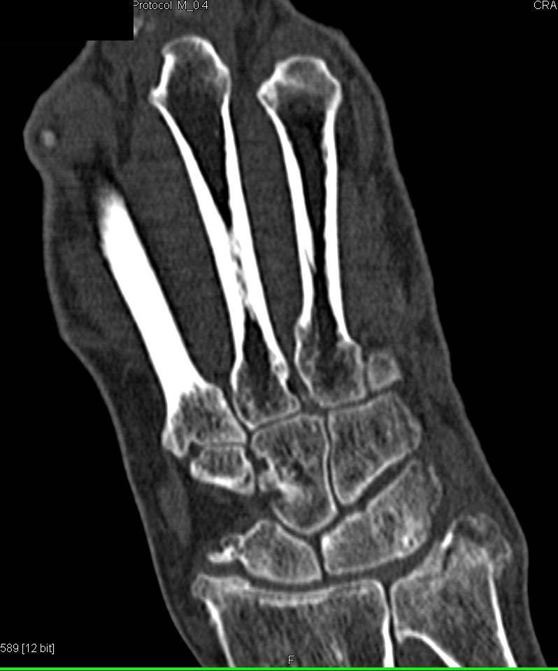 Prior Scaphoid Fracture - CTisus CT Scan