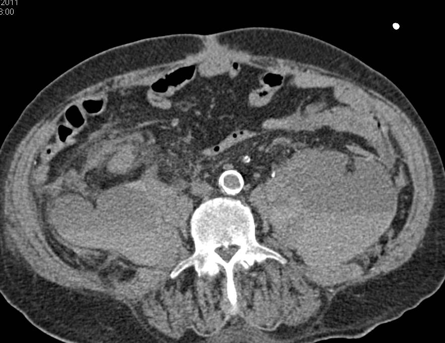 Bilateral Para-renal Bleeds - CTisus CT Scan