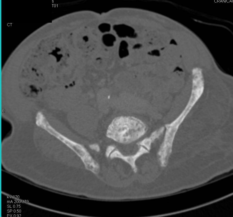 Metastatic B to Bonereast Cancer - CTisus CT Scan