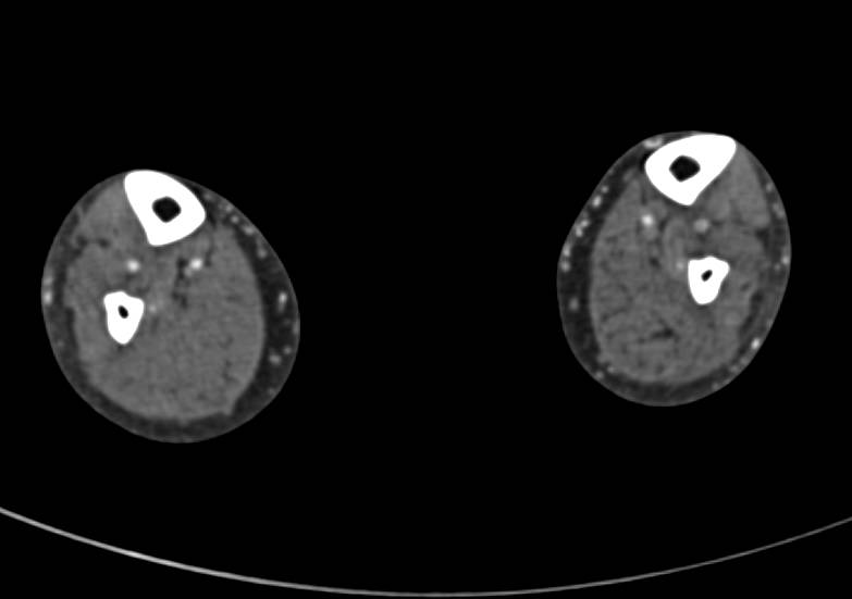 Soft Tissue Calcification in a Patient with Chronic Renal Disease - CTisus CT Scan