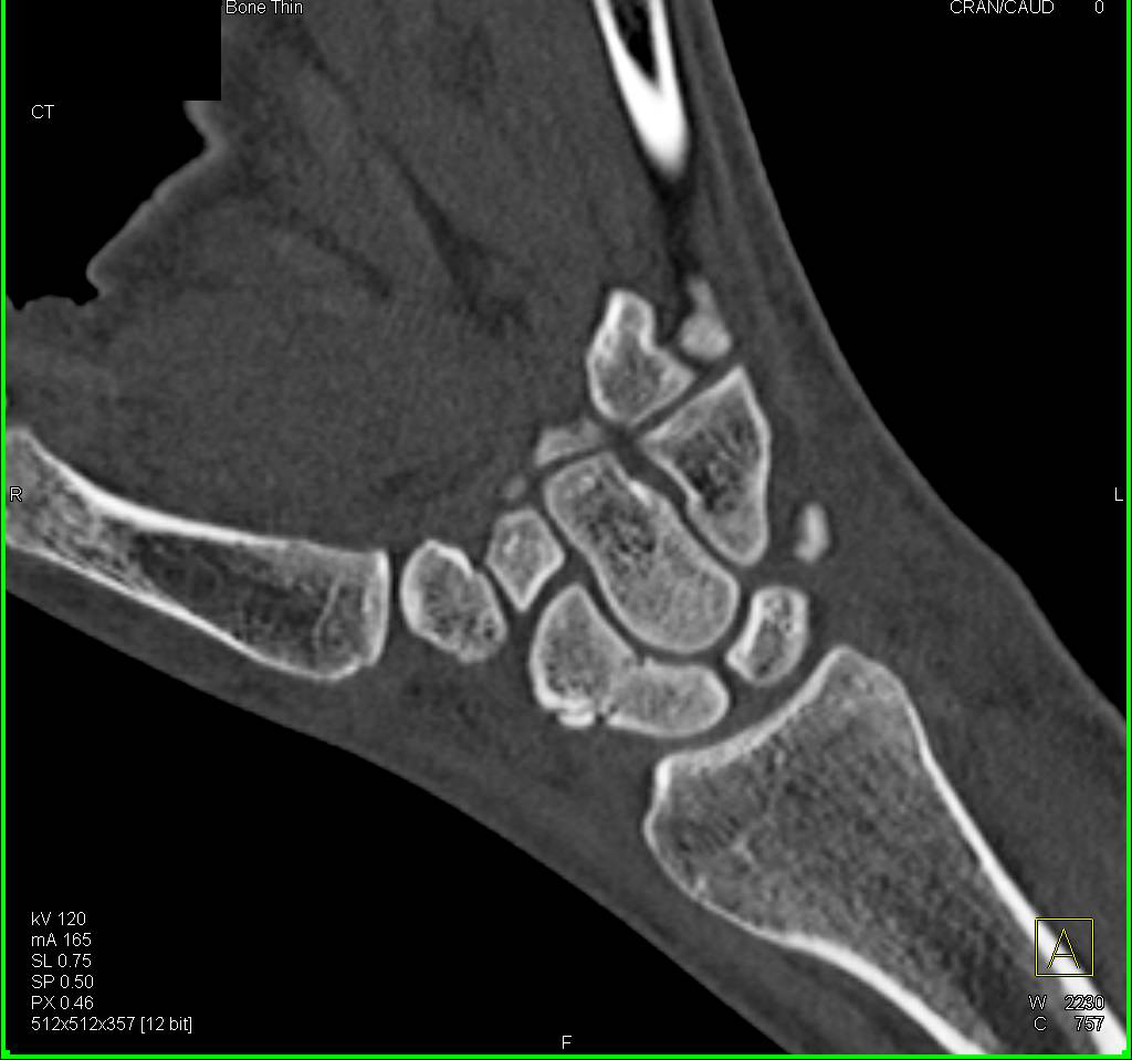 Scaphoid Fracture - CTisus CT Scan