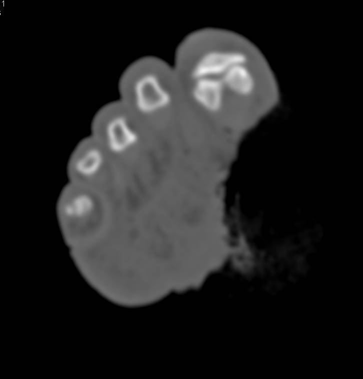 Ulceration Near Head of First Metatarsal - CTisus CT Scan
