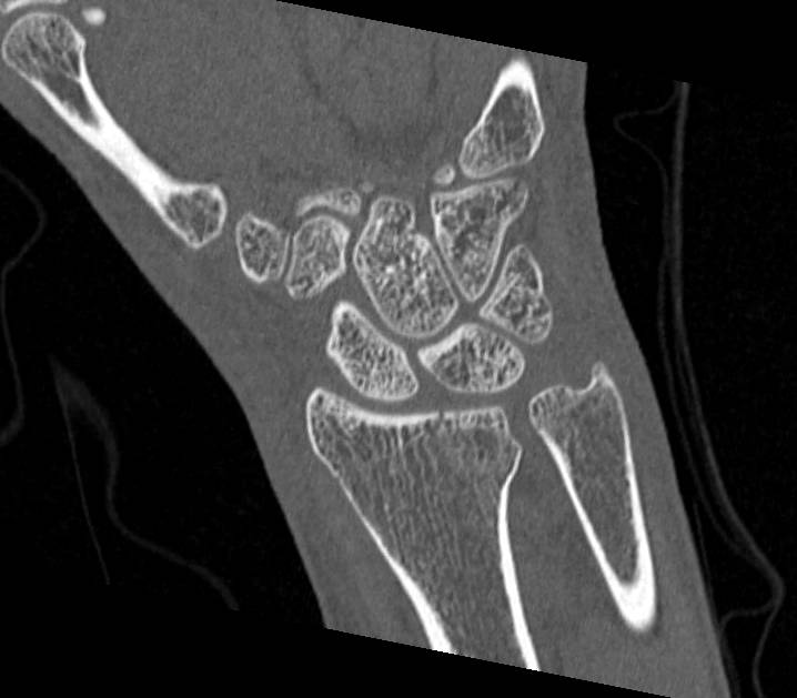 Intra-articular Radius Fracture with Carpal Fractures - CTisus CT Scan