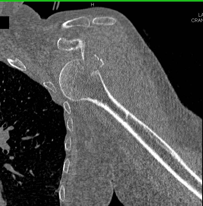 Dislocated Humerus with Fracture - CTisus CT Scan