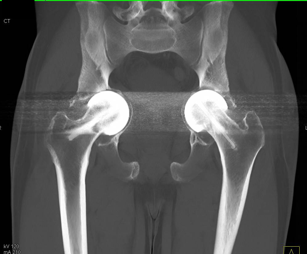 Bilateral Hip Replacement with Protrusio - CTisus CT Scan