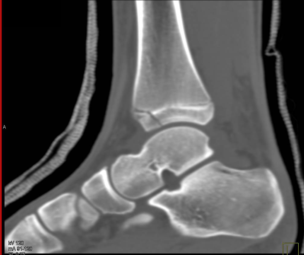 Tibial Fractures through the Epiphysis and Widening of the Epiphyseal Plate - CTisus CT Scan