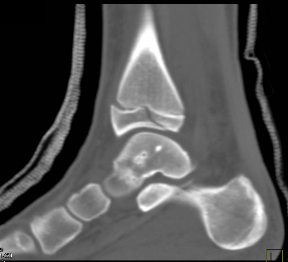Tibial Fractures thru the Epiphysis and Widening of the Epiphyseal ...