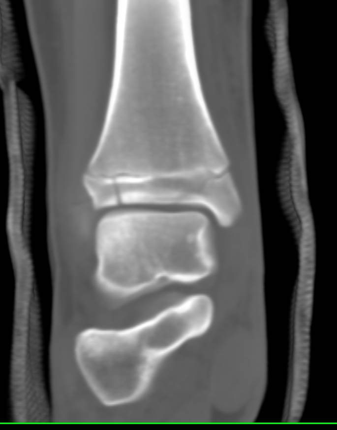 Tibial Fractures thru the Epiphysis and Widening of the Epiphyseal ...