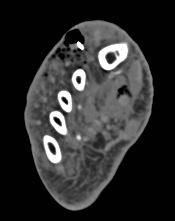 Puncture Wound with Foreign Body and Gas Gangrene Developing - CTisus CT Scan
