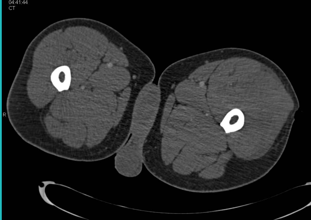 Stab Wound Thigh with Bleed and Part of Broken Blade Seen on CTA - CTisus CT Scan