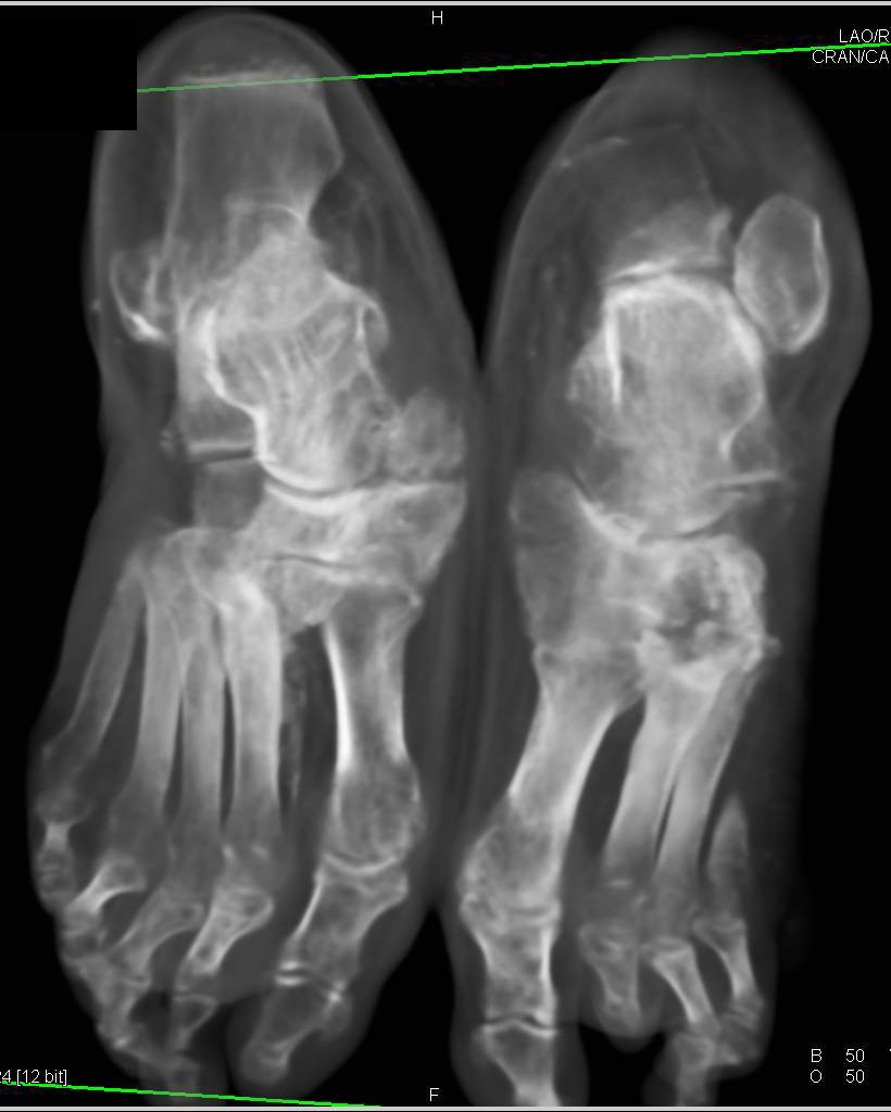 Neuropathic Changes Especially in the Midfoot Tarsal Bones - CTisus CT Scan