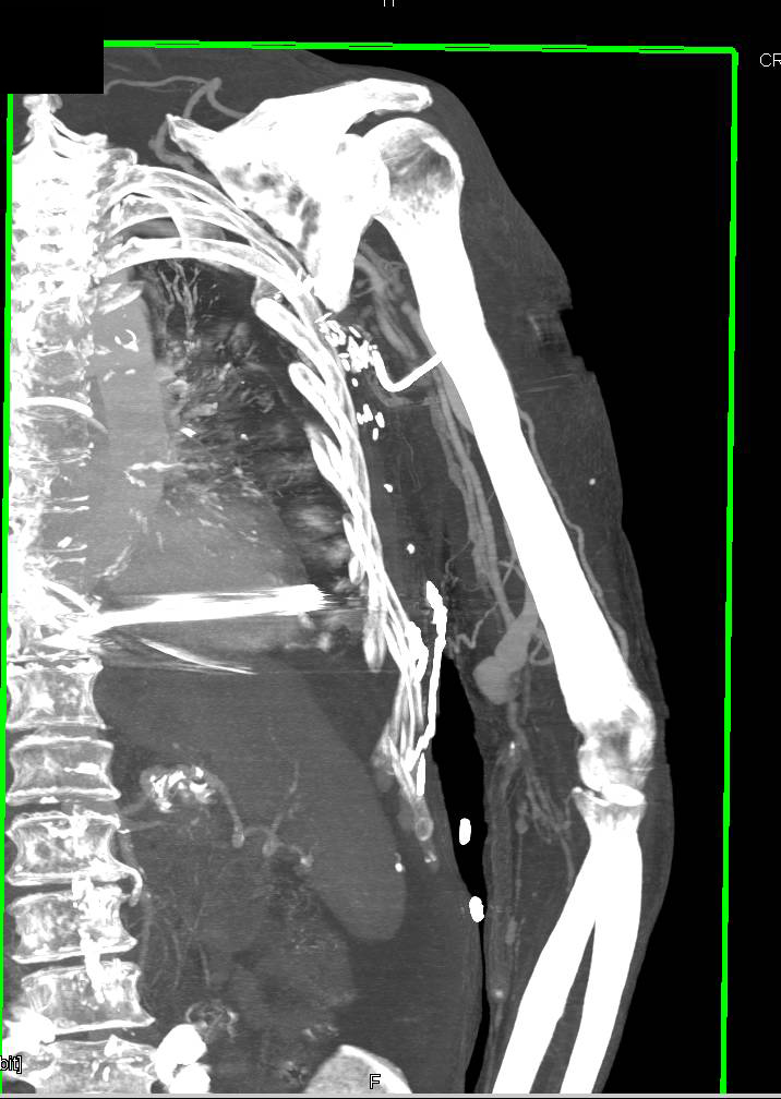 Arteriovenous (AV) Fistulae Arm in Dialysis Patient - CTisus CT Scan