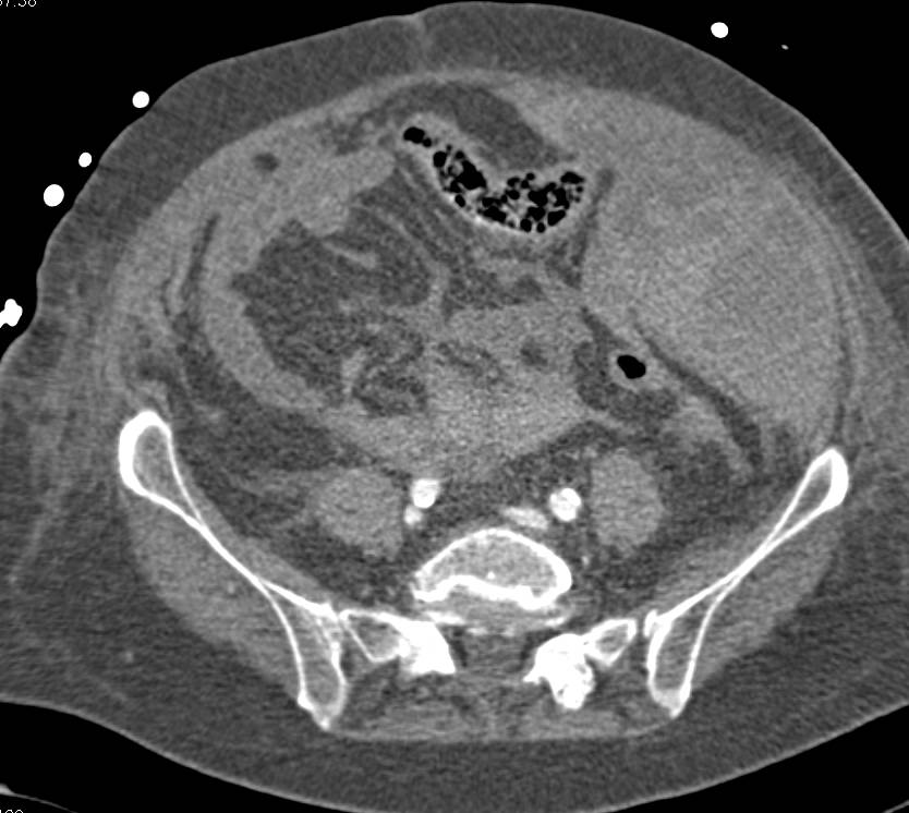 Spontaneous Left Rectus Muscle and Left Lower Quadrant Bleed due to Anticoagulant Therapy - CTisus CT Scan