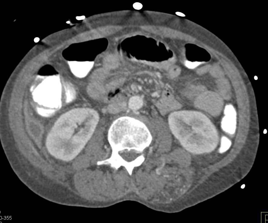 Hemangioma in the Left Paraspinal Muscles - CTisus CT Scan