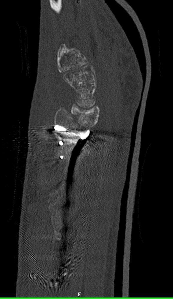 Healing Fracture with Osteoporosis - CTisus CT Scan