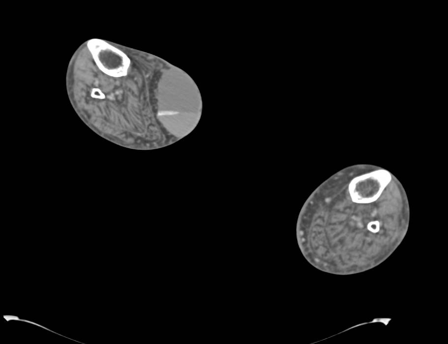 Hematoma in the Calf - CTisus CT Scan