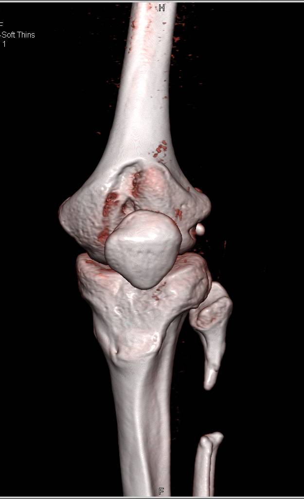 Bony Deformity with Remodelng of Tibia - CTisus CT Scan