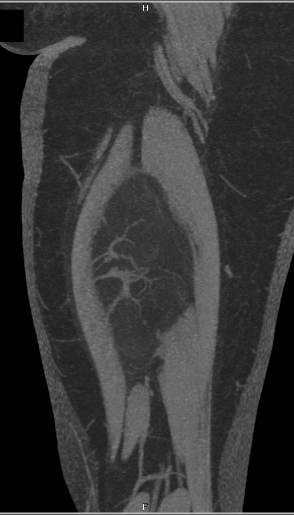 Liposarcoma - CTisus CT Scan