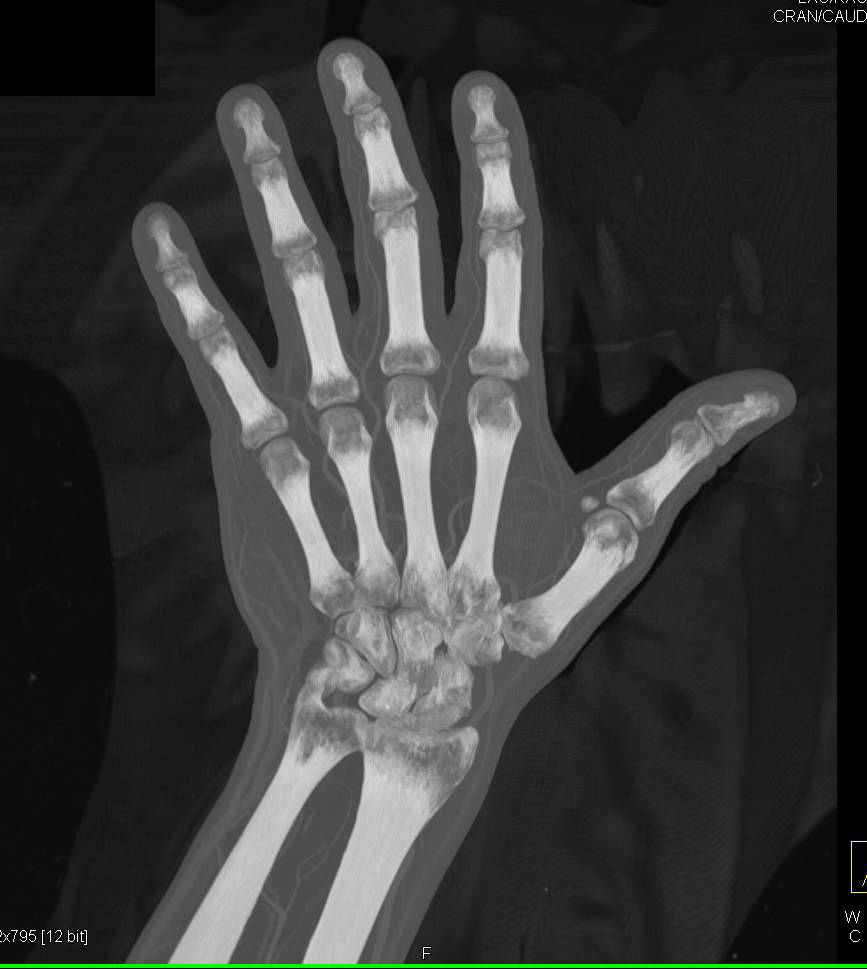 Cellulitis Without an Abscess and Nice 3D of an IV Line - CTisus CT Scan