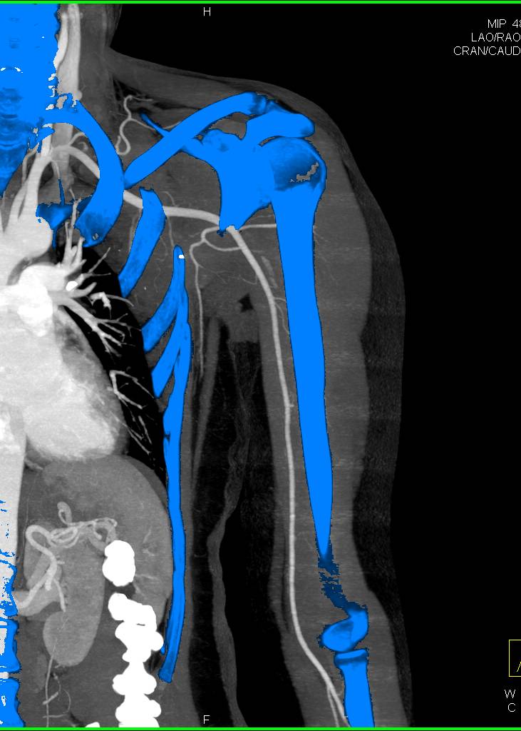 Vascular Renderings and Edits to Show Axillary Nodes and Axillary and Brachial Artery Relationships - CTisus CT Scan