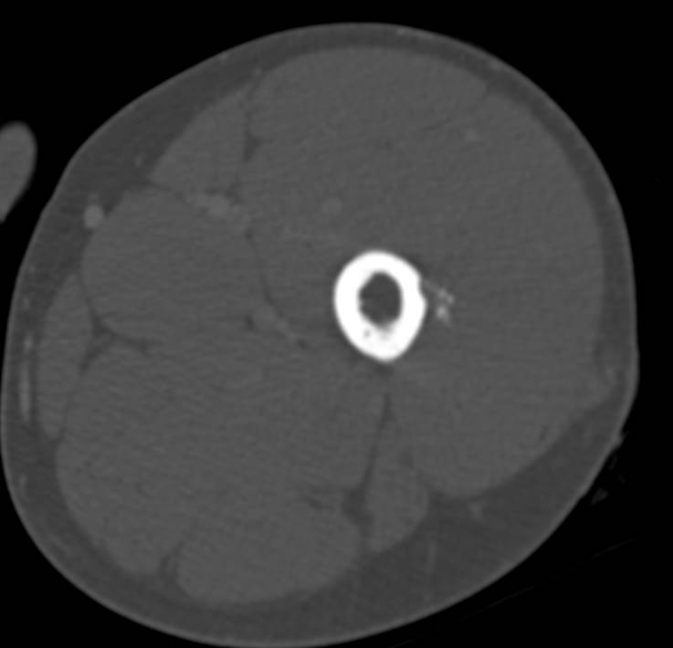 Prior Femur Trauma - CTisus CT Scan