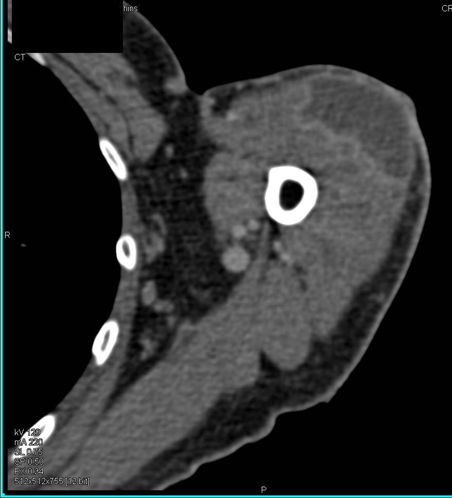 Abscess in the Deltoid Muscle - CTisus CT Scan