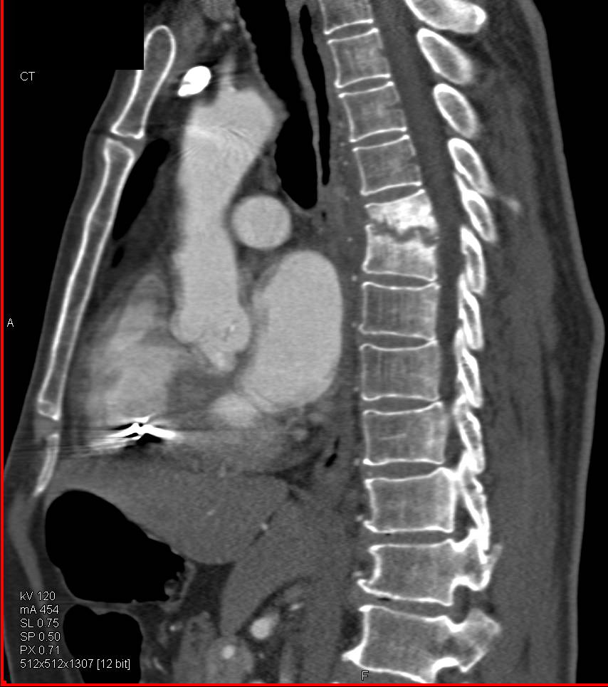 Osteomyelitis as an Unsuspected Finding on Chest CT - CTisus CT Scan