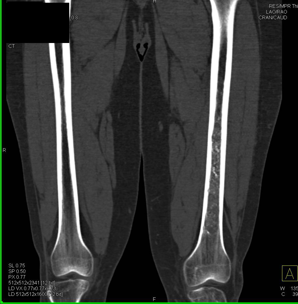 Bone Infarcts - CTisus CT Scan