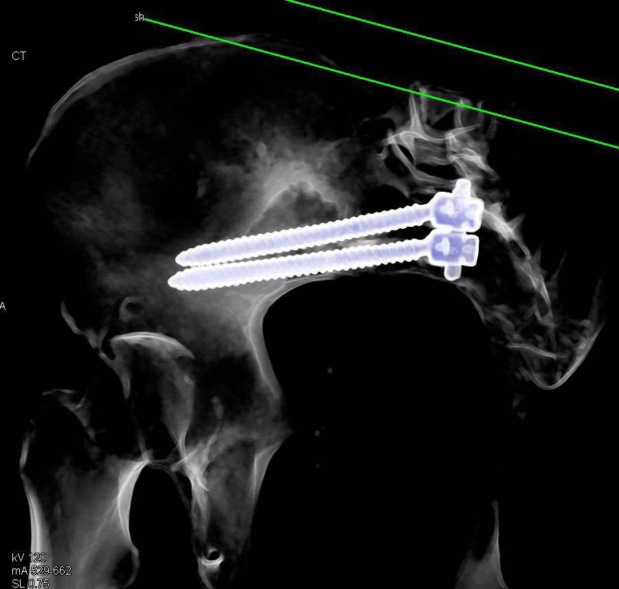 Pins in Iliac Bone to Help Treat Stress Fracture - CTisus CT Scan