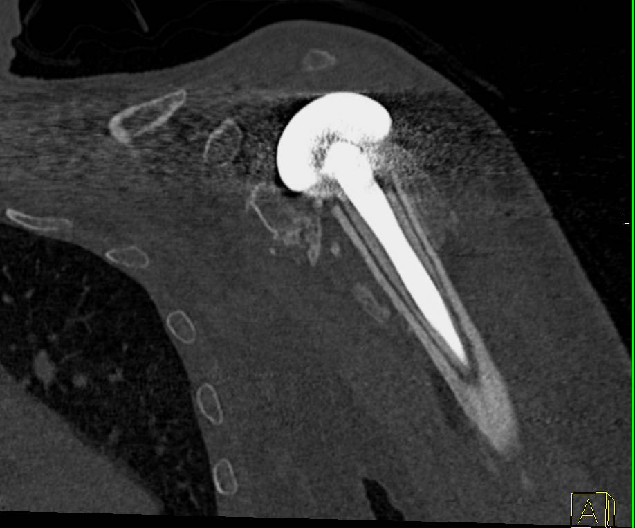 3D Map of Shoulder Prosthesis - CTisus CT Scan