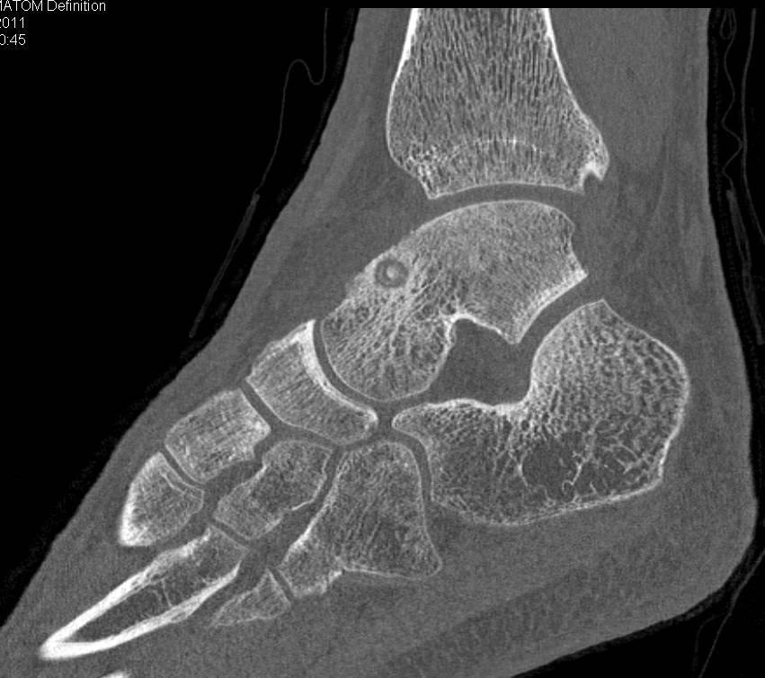 Osteoid Osteoma of the Talus - CTisus CT Scan