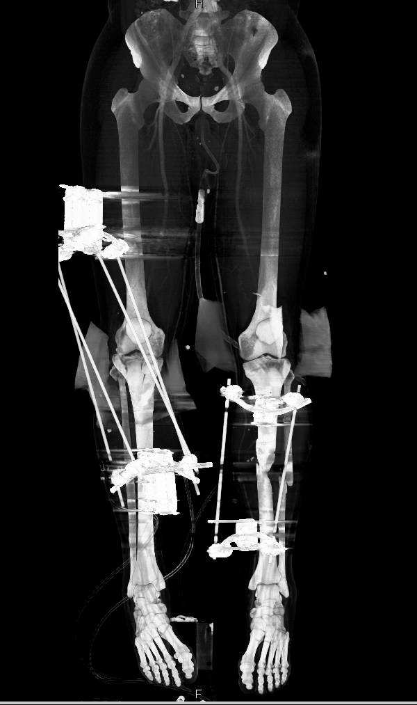 Hardware in 3D for External Fixation of Multiple Fractures - CTisus CT Scan